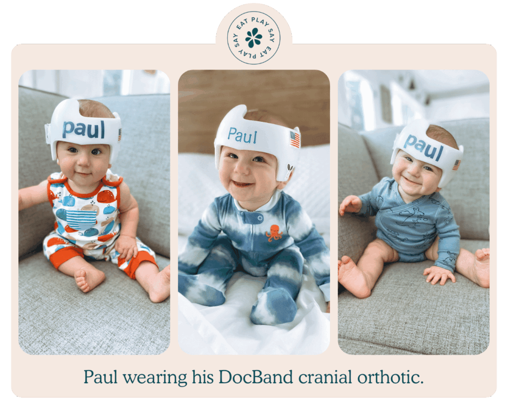 Collage of baby Paul wearing his DocBand from Cranial Technologies