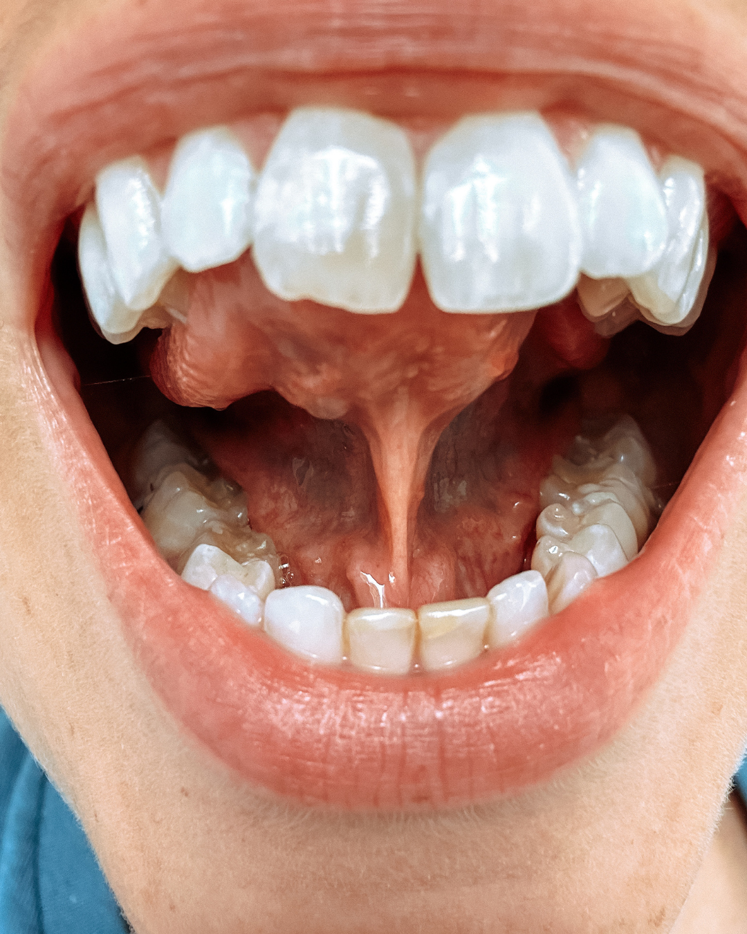  Picture of frenula under tongue. 