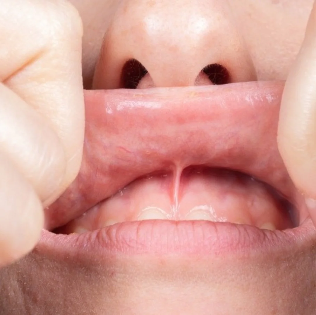  Picture of frenula under lip. 