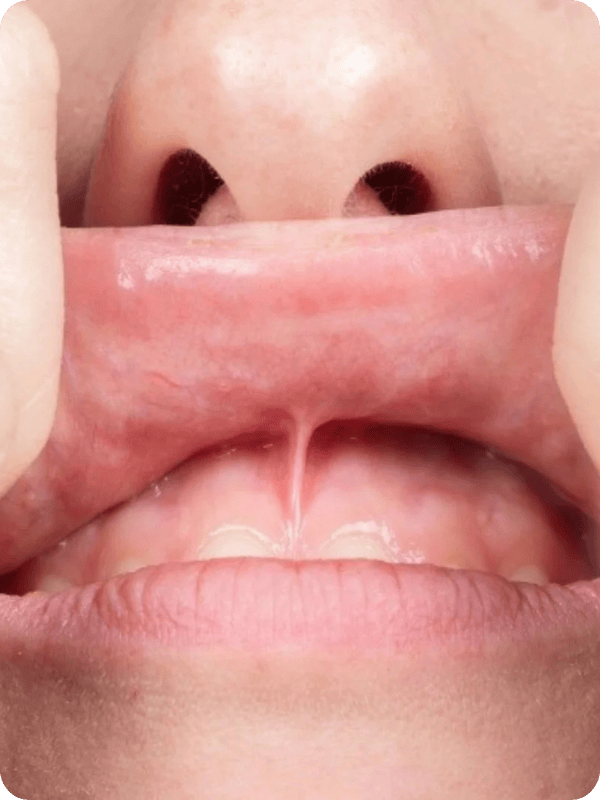 Frenulum under top lip