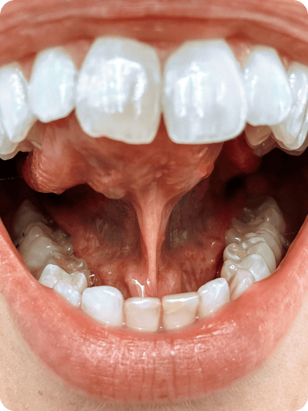 Frenulum under the tongue